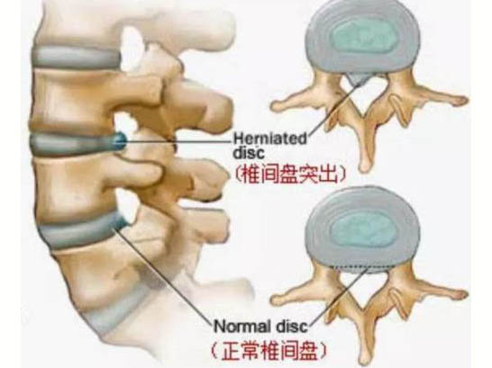 無菌性炎癥致痛學說與頸肩腰腿痛的發(fā)病機制